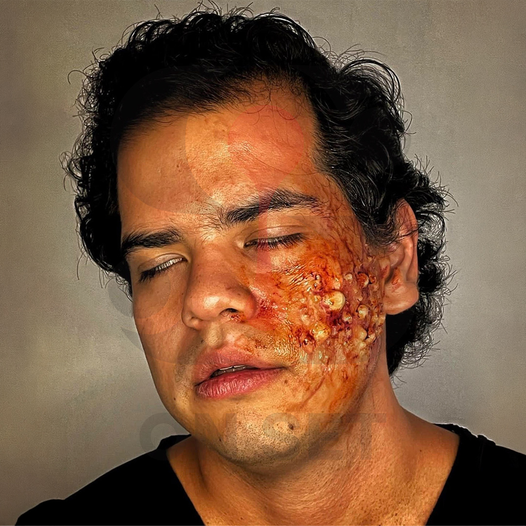 (ONSET) Prostético de Infección